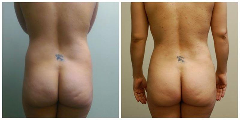 Aesthetic Surgery Institute bbl result — Houston, TX