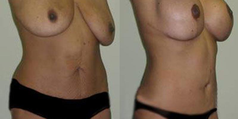 Aesthetic Surgery Institute mommy makeover result — Houston, TX