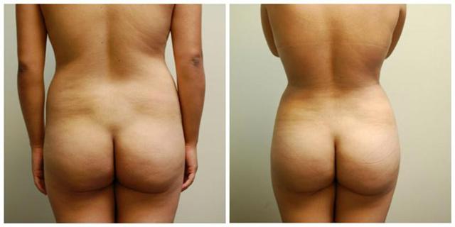 Brazilian Butt Lift result at Aesthetic Surgery Institute in Houston, TX