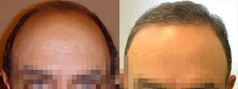 Aesthetic Surgery Institute hair restoration result — Houston, TX