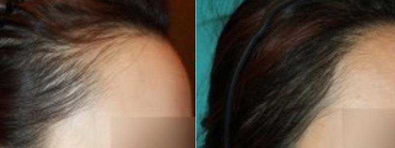Aesthetic Surgery Institute hair restoration result — Houston, TX