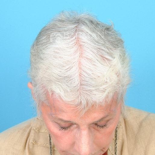 Bauman Medical (Alan J. Bauman, MD) laser hair therapy after — Boca Raton, FL