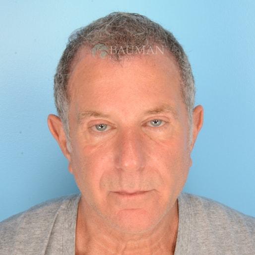 Bauman Medical (Alan J. Bauman, MD) fue hair transplant after — Boca Raton, FL