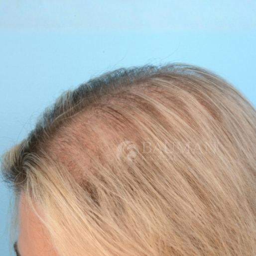 Bauman Medical (Alan J. Bauman, MD) prp for hair after — Boca Raton, FL