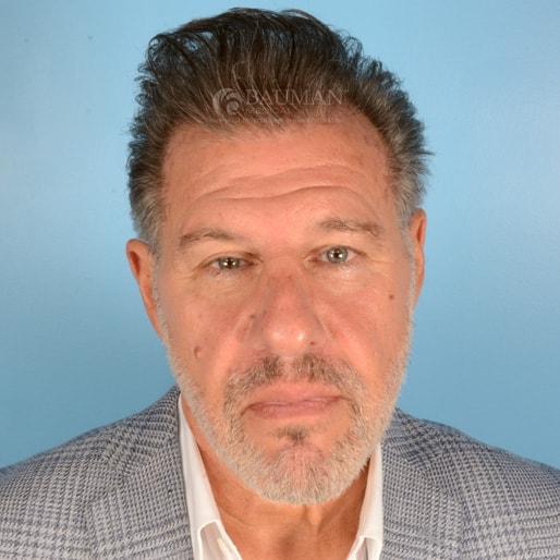 Bauman Medical (Alan J. Bauman, MD) fue hair transplant after — Boca Raton, FL