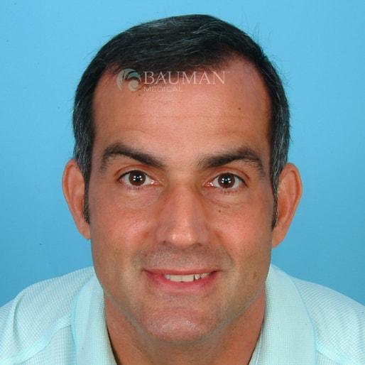 Bauman Medical (Alan J. Bauman, MD) fue hair transplant after — Boca Raton, FL