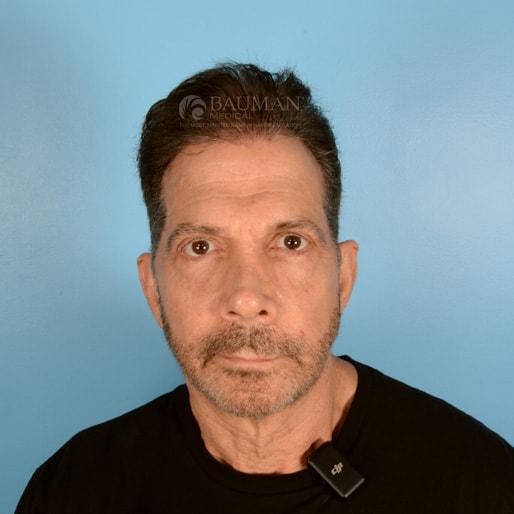 Bauman Medical (Alan J. Bauman, MD) fue hair transplant after — Boca Raton, FL