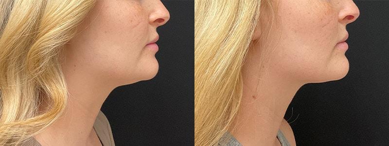 Your Cosmetic Office submental liposuction result — Encinitas, CA