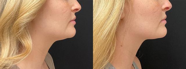 Neck Liposuction result at Your Cosmetic Office in Encinitas, CA