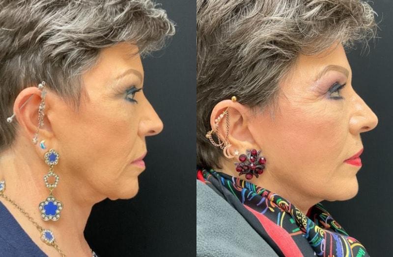 Your Cosmetic Office facelift result — Encinitas, CA