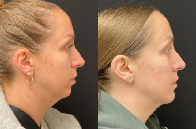 Neck Liposuction result at Your Cosmetic Office in Encinitas, CA