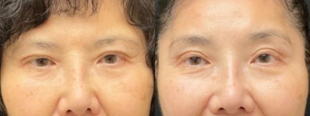 Brow Lift result at Your Cosmetic Office in Encinitas, CA