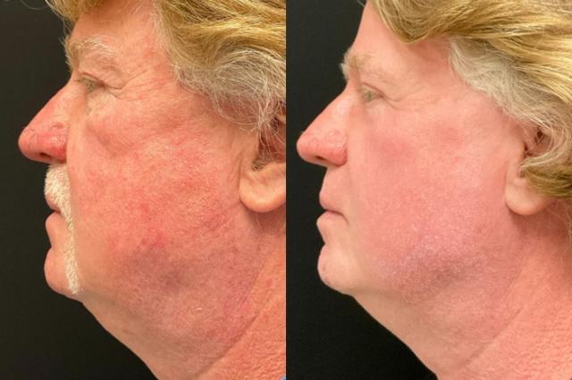 Laser Skin Resurfacing result at Your Cosmetic Office in Encinitas, CA