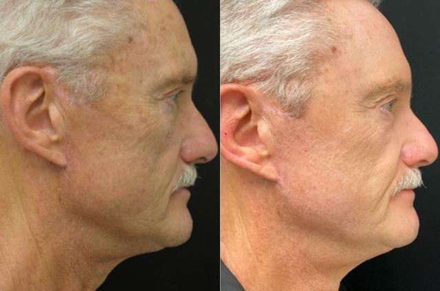 Laser Skin Resurfacing result at Your Cosmetic Office in Encinitas, CA