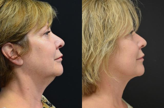 Neck Lift result at Your Cosmetic Office in Encinitas, CA