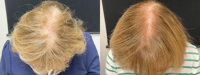 Your Cosmetic Office hair restoration result — Encinitas, CA