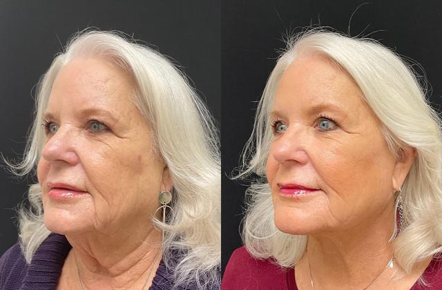 Deep Plane Facelift result at Your Cosmetic Office in Encinitas, CA