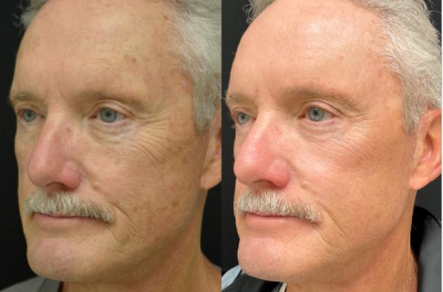 Laser Skin Resurfacing result at Your Cosmetic Office in Encinitas, CA