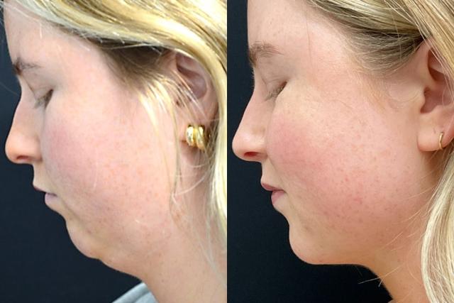 Neck Liposuction result at Your Cosmetic Office in Encinitas, CA