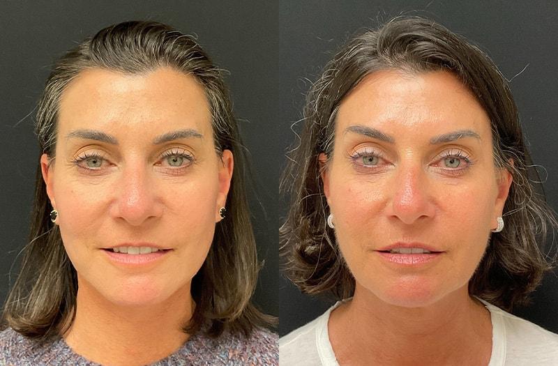 Your Cosmetic Office facelift result — Encinitas, CA