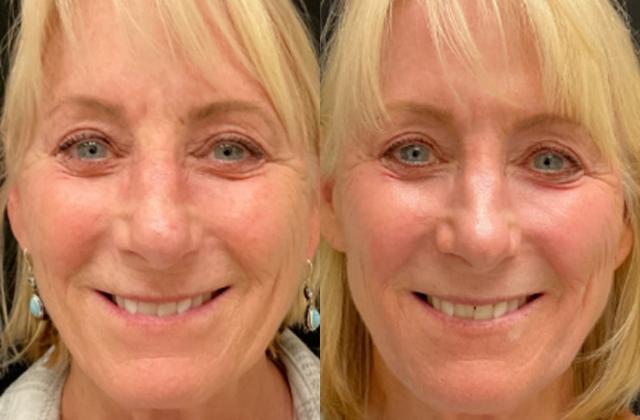 Laser Skin Resurfacing result at Your Cosmetic Office in Encinitas, CA
