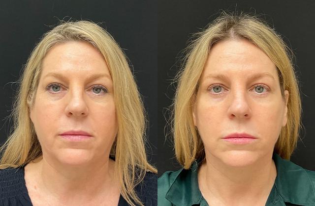 Deep Plane Facelift result at Your Cosmetic Office in Encinitas, CA
