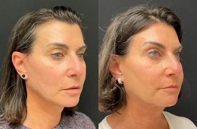 Deep Plane Facelift result at Your Cosmetic Office in Encinitas, CA