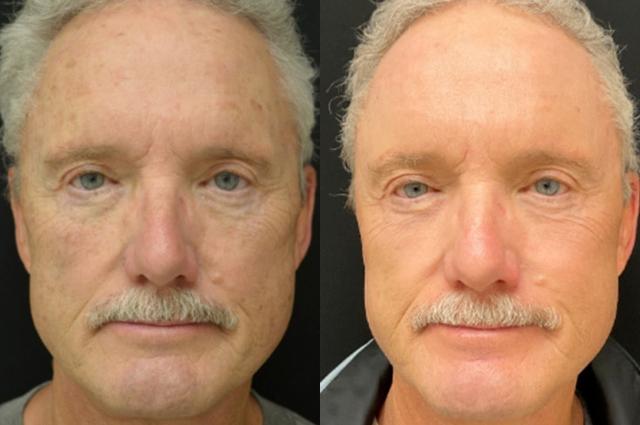 Laser Skin Resurfacing result at Your Cosmetic Office in Encinitas, CA