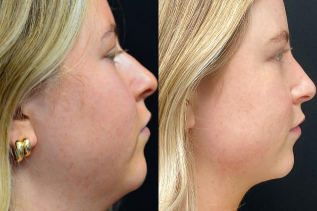 Neck Liposuction result at Your Cosmetic Office in Encinitas, CA