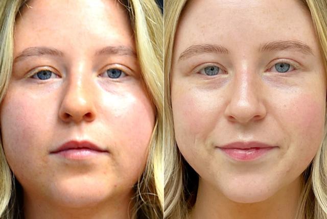 Neck Liposuction result at Your Cosmetic Office in Encinitas, CA
