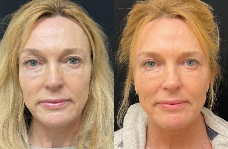 Your Cosmetic Office fat transfer result — Encinitas, CA
