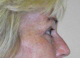 Koger Cosmetic Clinic & Medspa eyelid lift after — Jupiter, FL