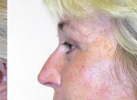 Koger Cosmetic Clinic & Medspa eyelid lift after — Jupiter, FL