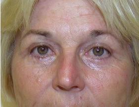 Koger Cosmetic Clinic & Medspa eyelid lift after — Jupiter, FL