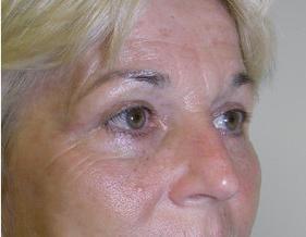 Koger Cosmetic Clinic & Medspa eyelid lift after — Jupiter, FL
