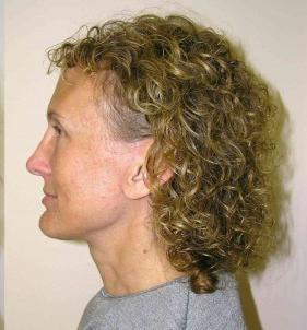 Koger Cosmetic Clinic & Medspa rhinoplasty after — Jupiter, FL