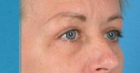 Koger Cosmetic Clinic & Medspa eyelid lift after — Jupiter, FL