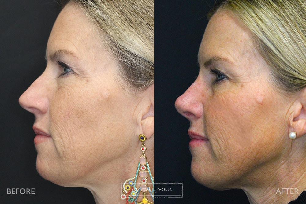Salvatore J Pacella, MD Cosmetic & Plastic Surgery rhinoplasty result — San Diego, CA