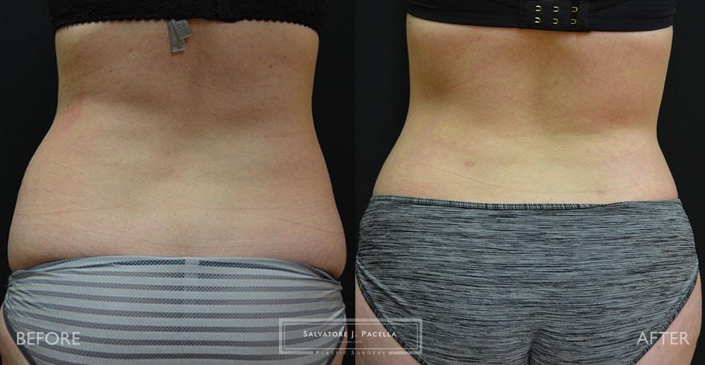 Salvatore J Pacella, MD Cosmetic & Plastic Surgery tummy tuck result — San Diego, CA