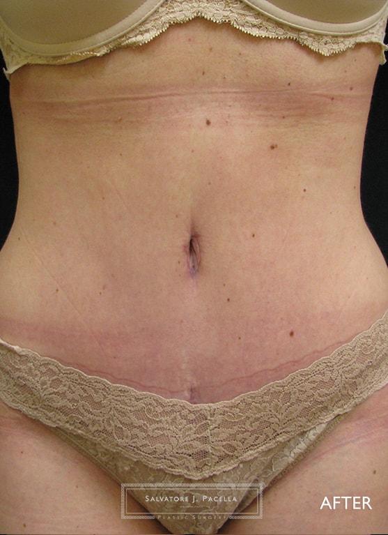 Mini Tummy Tuck after at Salvatore J Pacella, MD Cosmetic & Plastic Surgery in San Diego, CA