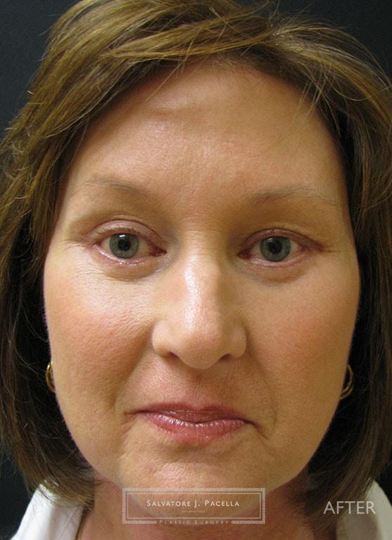 Salvatore J Pacella, MD Cosmetic & Plastic Surgery blepharoplasty after — San Diego, CA