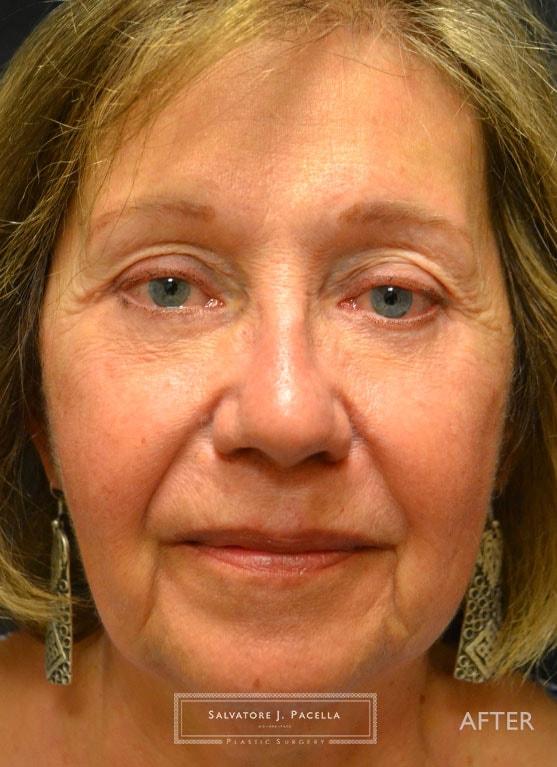 Salvatore J Pacella, MD Cosmetic & Plastic Surgery blepharoplasty after — San Diego, CA