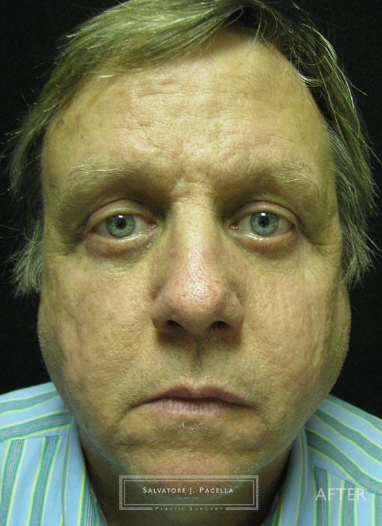 Salvatore J Pacella, MD Cosmetic & Plastic Surgery blepharoplasty after — San Diego, CA
