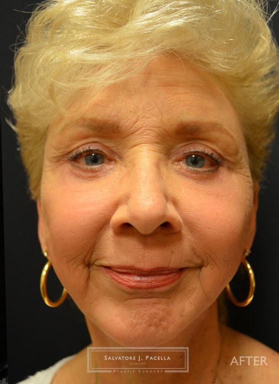 Facelift after at Salvatore J Pacella, MD Cosmetic & Plastic Surgery in San Diego, CA