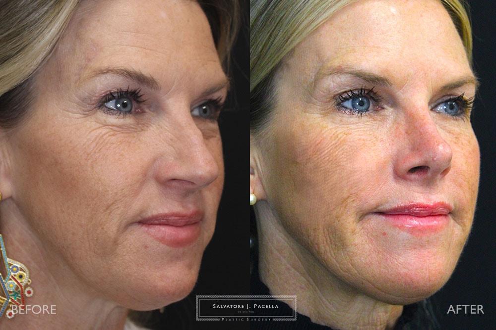 Salvatore J Pacella, MD Cosmetic & Plastic Surgery rhinoplasty result — San Diego, CA