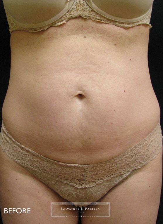 Mini Tummy Tuck before at Salvatore J Pacella, MD Cosmetic & Plastic Surgery in San Diego, CA