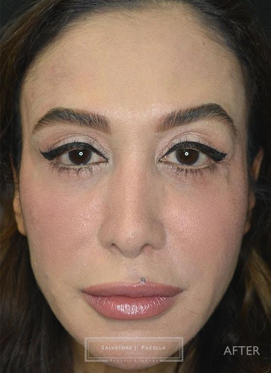 Salvatore J Pacella, MD Cosmetic & Plastic Surgery blepharoplasty after — San Diego, CA