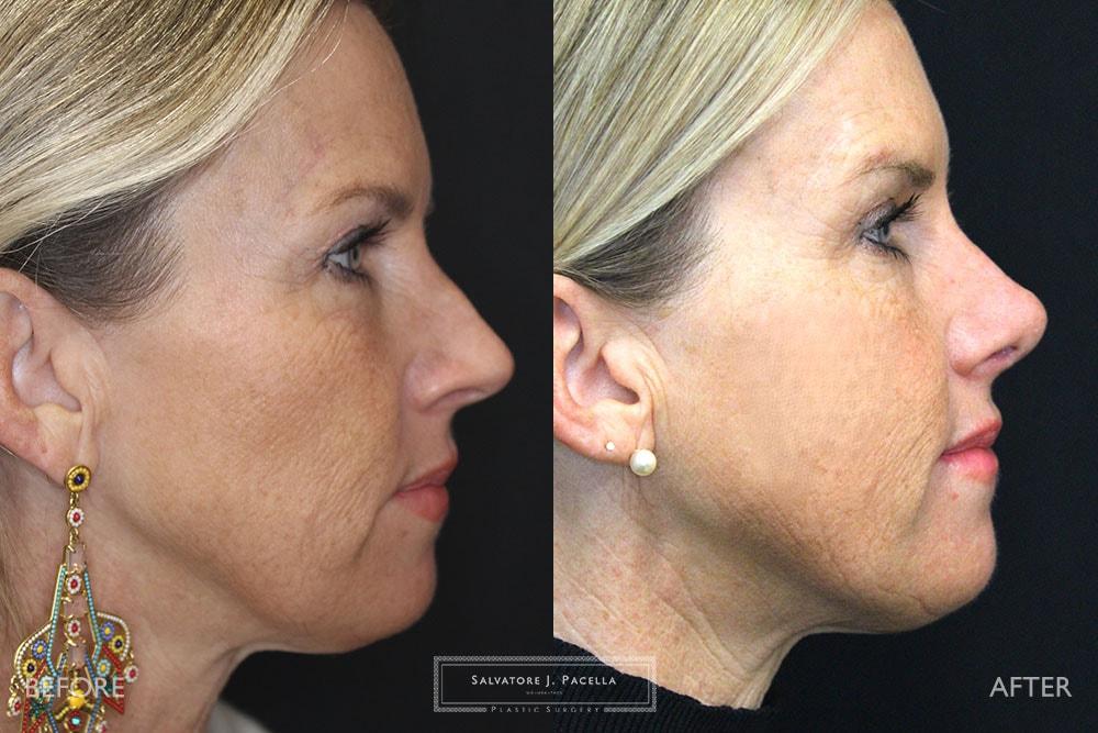 Salvatore J Pacella, MD Cosmetic & Plastic Surgery rhinoplasty result — San Diego, CA
