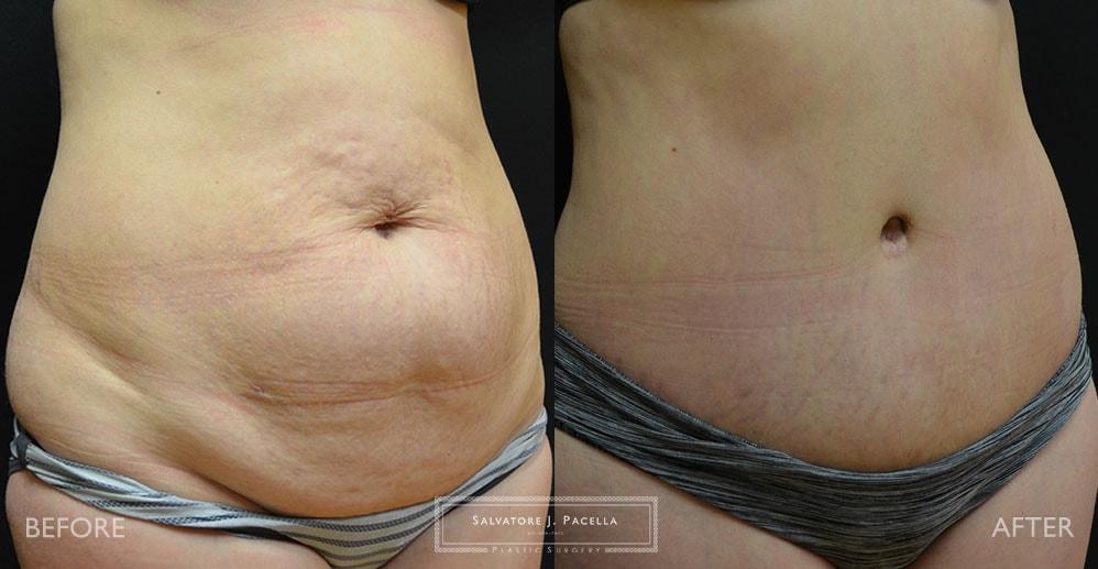 Salvatore J Pacella, MD Cosmetic & Plastic Surgery tummy tuck result — San Diego, CA
