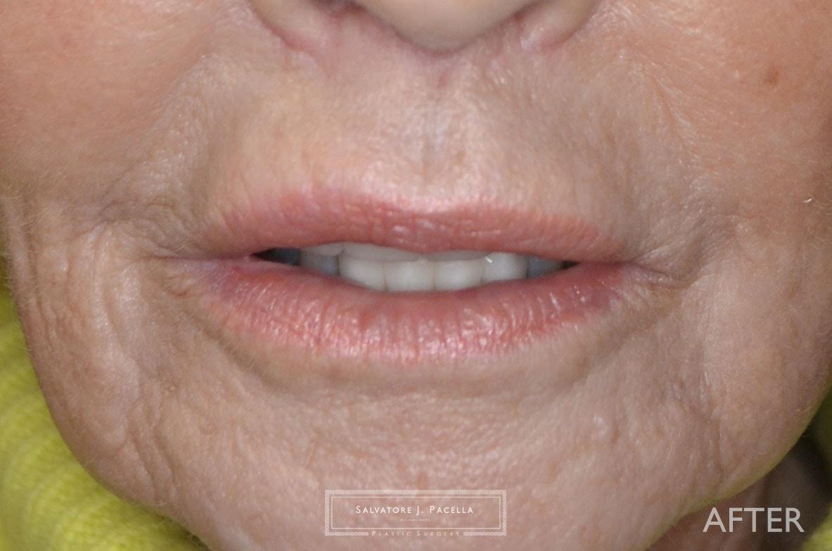 Salvatore J Pacella, MD Cosmetic & Plastic Surgery lip lift after — San Diego, CA